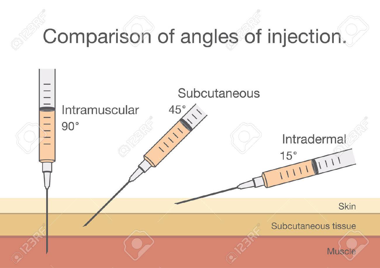 Como colocar una inyeccion intramuscular en el brazo