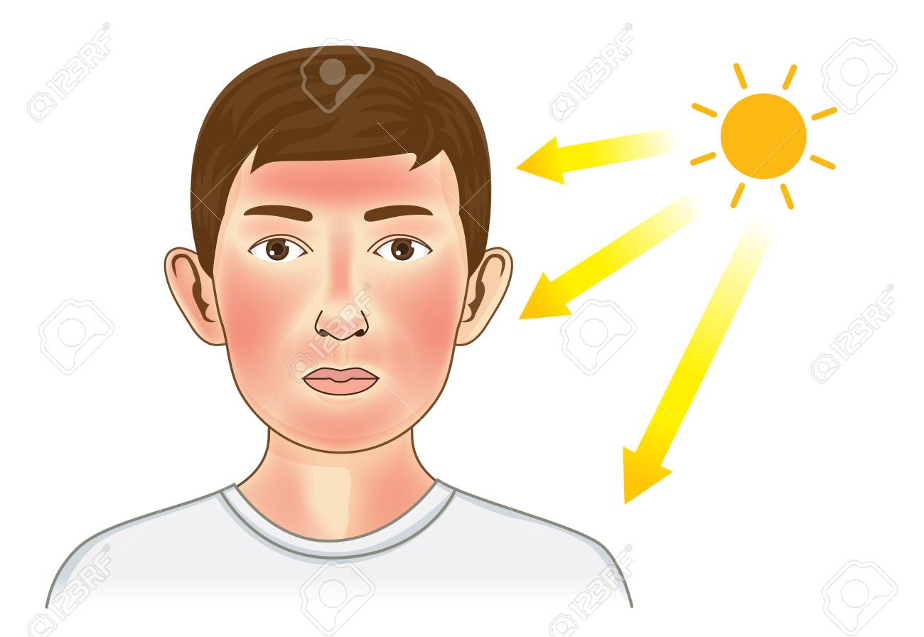 Los Rayos Ultravioleta Del Sol Hacen Que Aparezca El Enrojecimiento En La Piel Del Niño Y Del Cuello. Ilustración Sobre El Peligro De Los Rayos Uv. Ilustraciones Svg, Vectoriales, Clip Art Vectorizado Los Rayos Ultravioleta Del Sol Hacen Que Aparezca El Enrojecimiento En La Piel Del Niño Y Del Cuello. Ilustración Sobre El Peligro De Los Rayos Uv. Ilustraciones Svg, Vectoriales, Clip Art Vectorizado