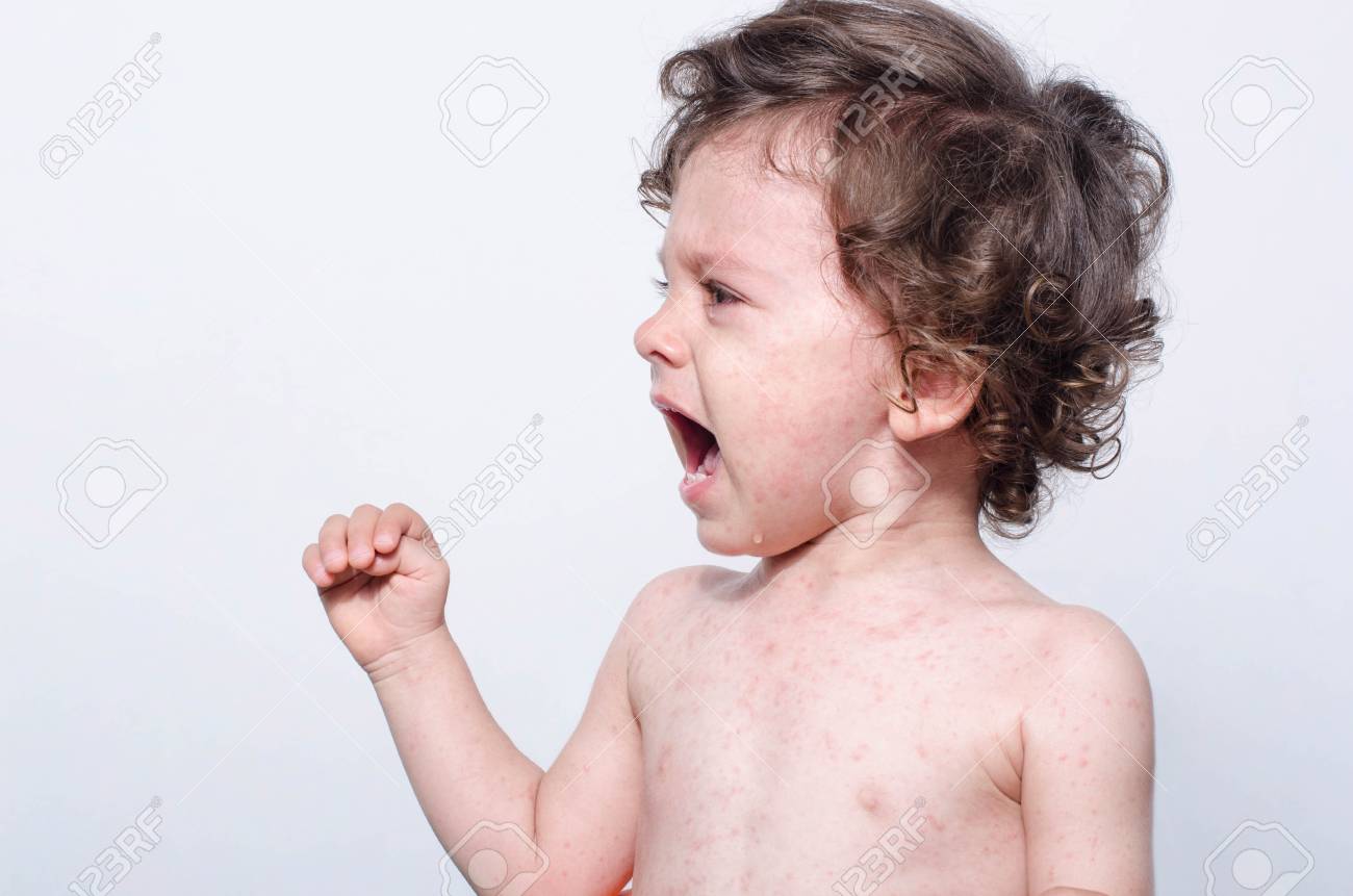 Portrait D Un Mignon Petit Garcon Malade Qui Pleure Adorable Enfant Contrarie Avec Des Taches Sur Son Visage Et Son Corps Qui Forment La Maladie Les Piqures De Moustiques La Roseole La Rubeole Portrait D Un Mignon Petit Garcon Malade Qui Pleure Adorable Enfant Contrarie Avec Des Taches Sur Son Visage Et Son Corps Qui Forment La Maladie Les Piqures De Moustiques La Roseole La Rubeole
