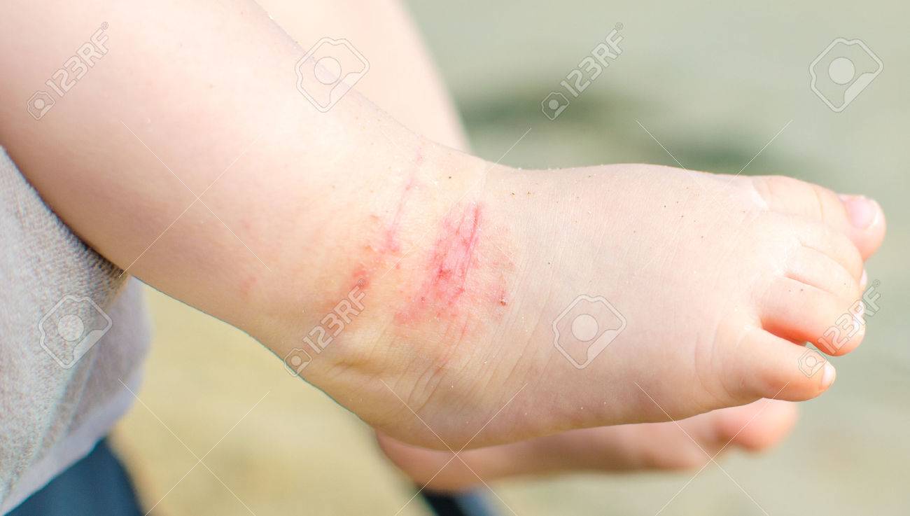 eczema pierna picor