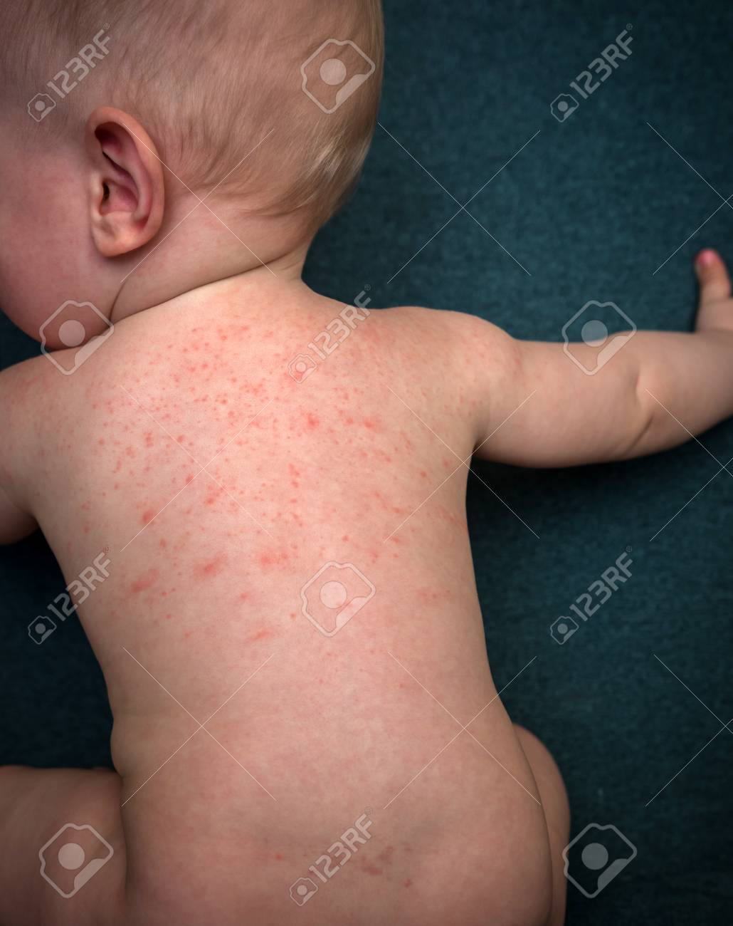 Allergies, boutons sur la peau du bébé. Allergie alimentaire. Maladies de la peau, symptômes. Allergies, boutons sur la peau du bébé. Allergie alimentaire. Maladies de la peau, symptômes.