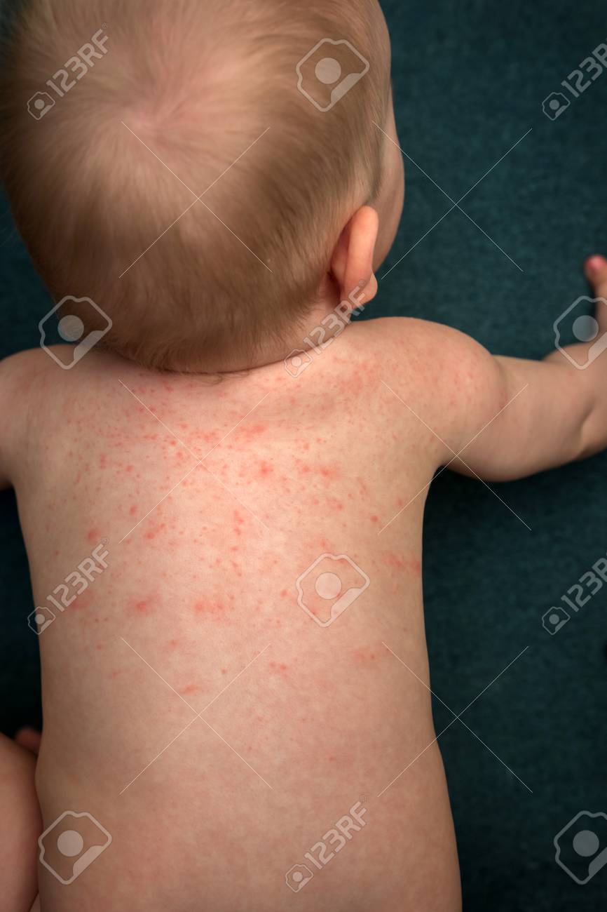 Alergia en bebes de a los sintomas alimentos