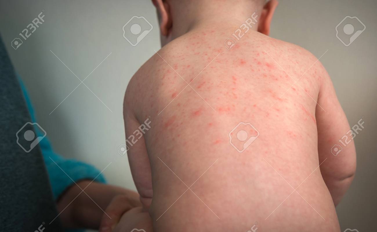Alergia en la cara granos