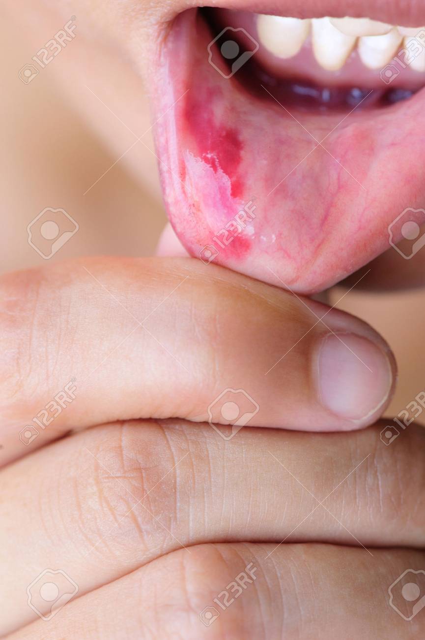 女性は傷害で口の中の下唇を表示します の写真素材 画像素材 Image