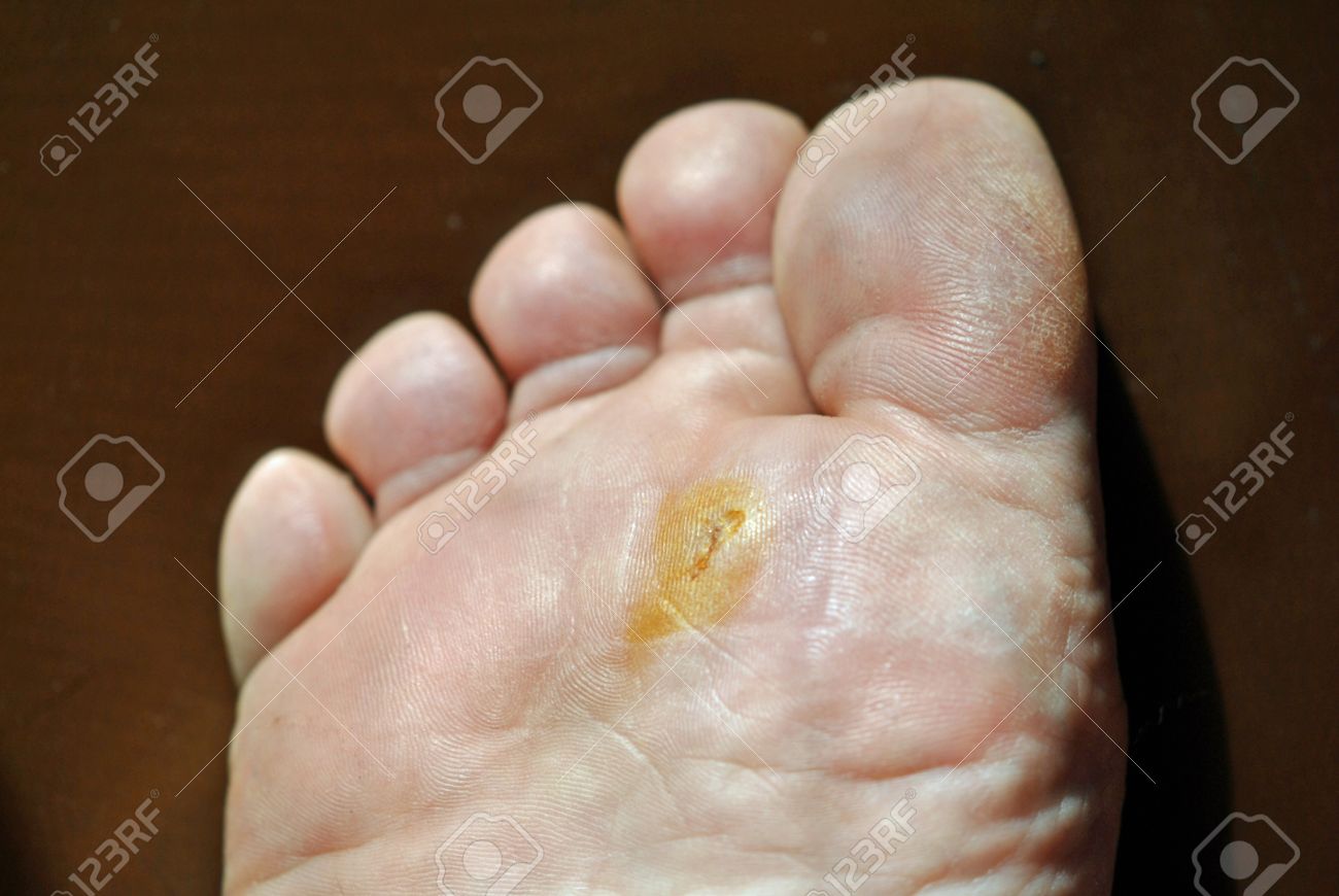 Splinter bottom foot Eleanor asshole fever