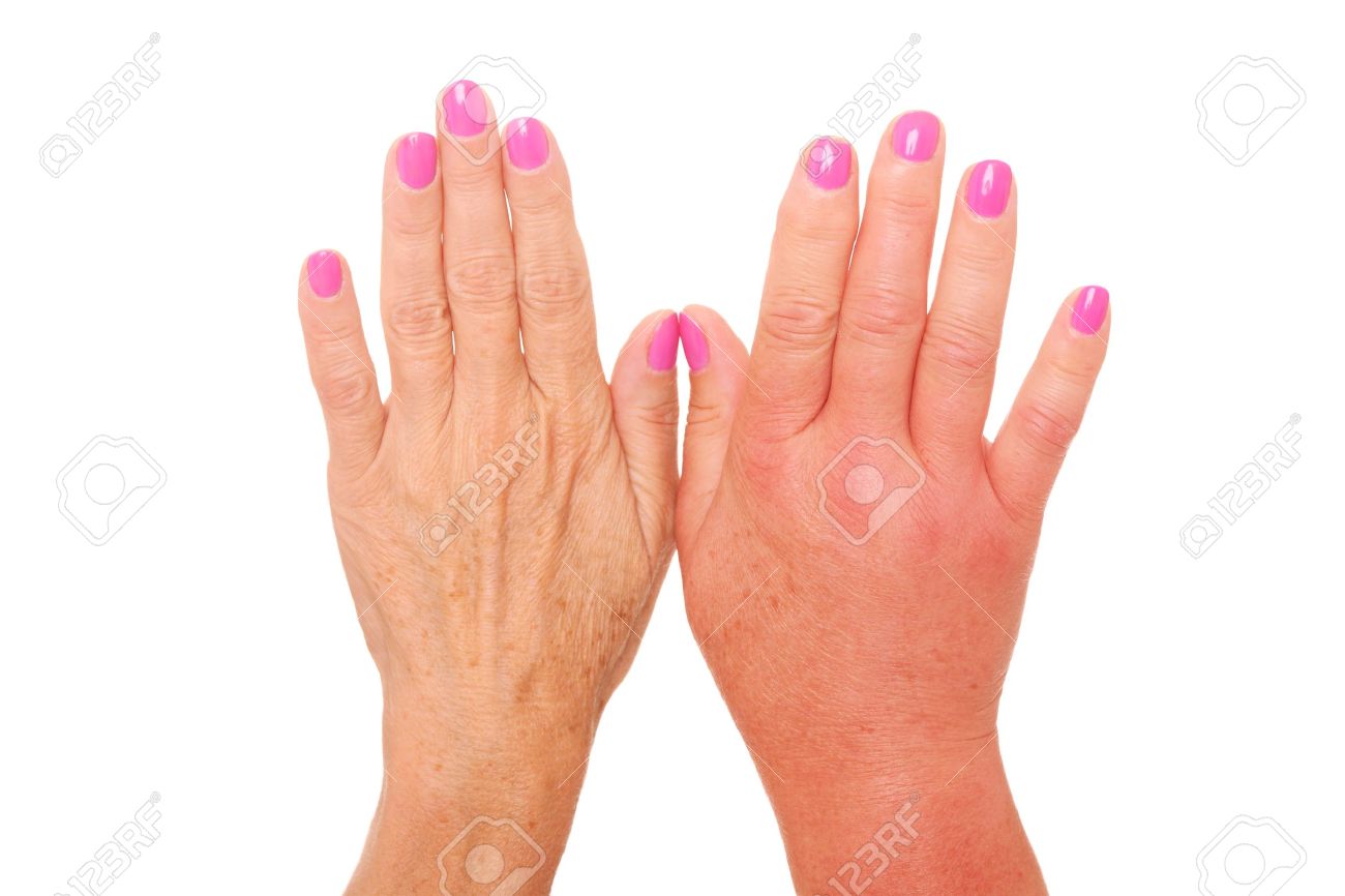 A Picture Of Female Hands One Swollen Because Of A Wasp Sting Over White  Background Stock Photo, Picture and Royalty Free Image. Image 21464921.