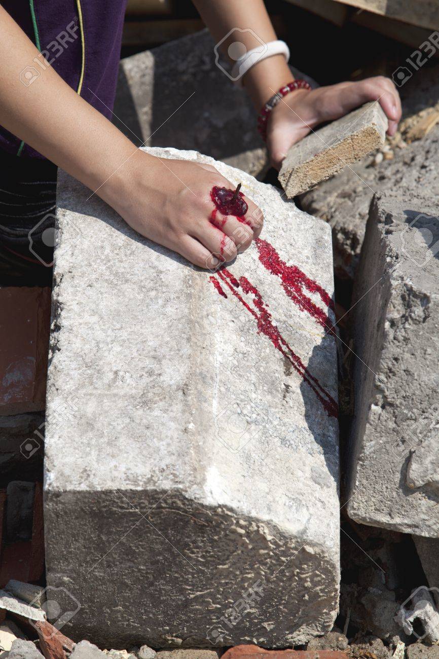 腕の怪我 の写真素材 画像素材 Image