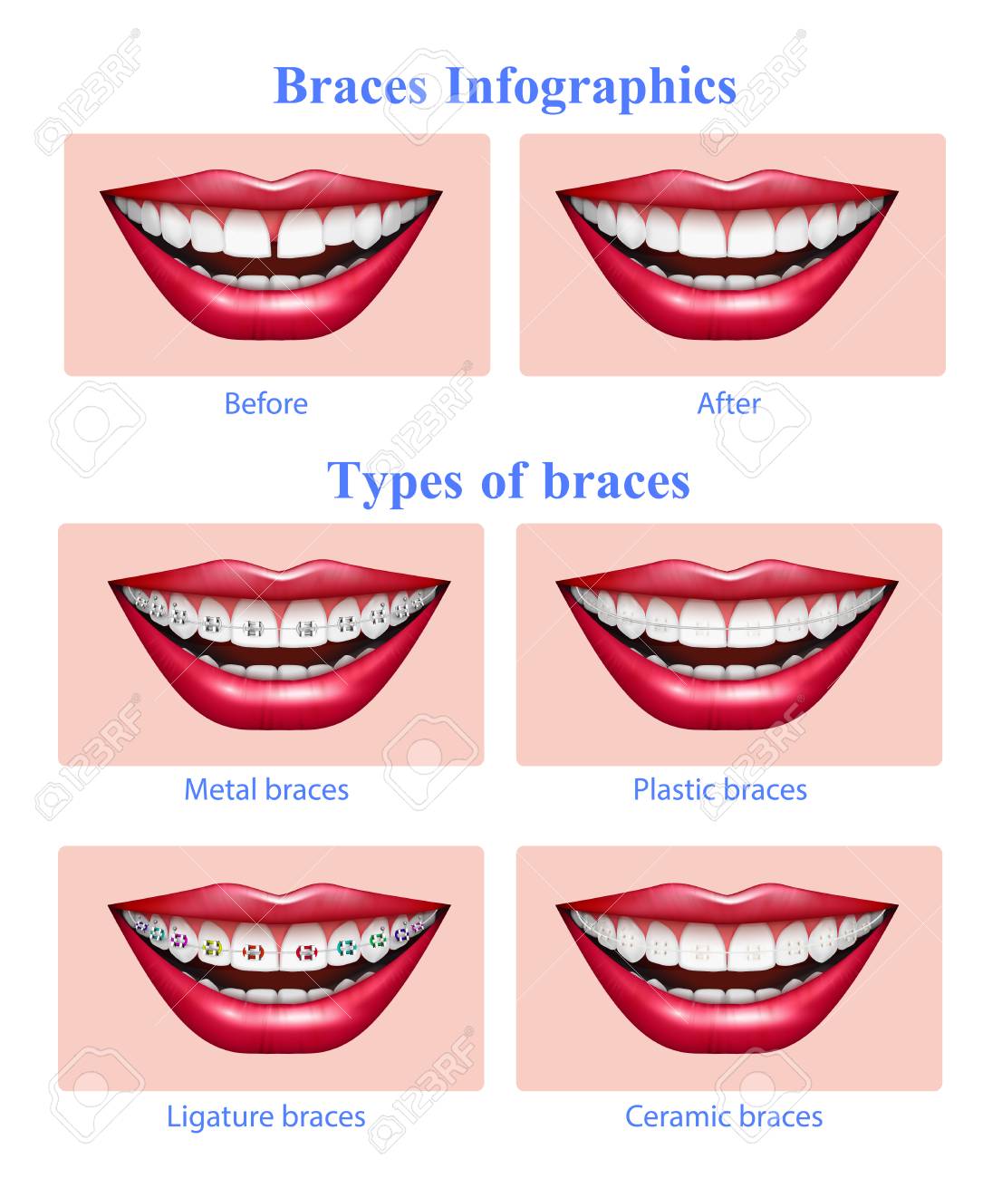 Opened mouth with red glossy lips showing metal plastic ceramic teeth braces types realistic infographic vector illustration - 113845028 Opened mouth with red glossy lips showing metal plastic ceramic teeth braces types realistic infographic vector illustration - 113845028
