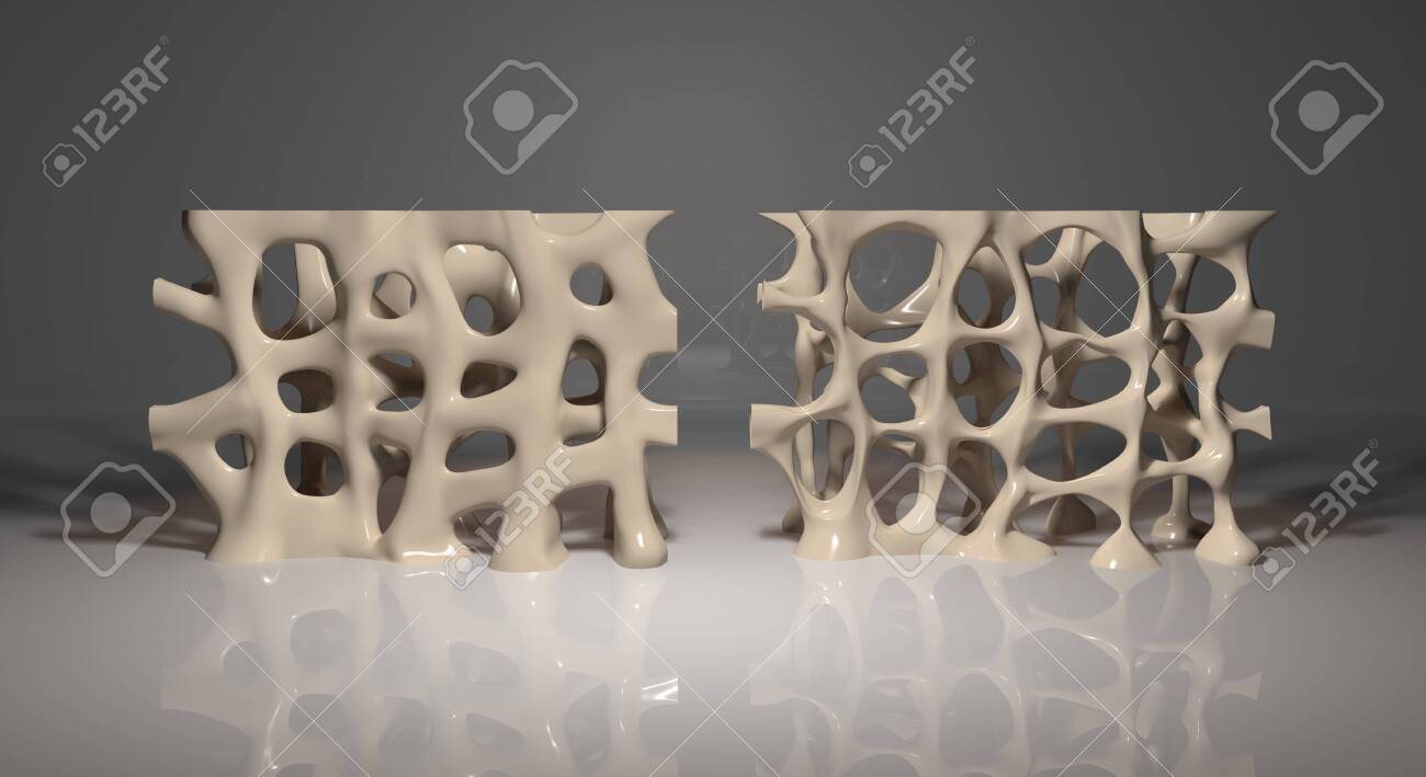 This 3d illustration shows a healthy bone segment compared to the same segment with osteoporosis - 144346031 This 3d illustration shows a healthy bone segment compared to the same segment with osteoporosis - 144346031