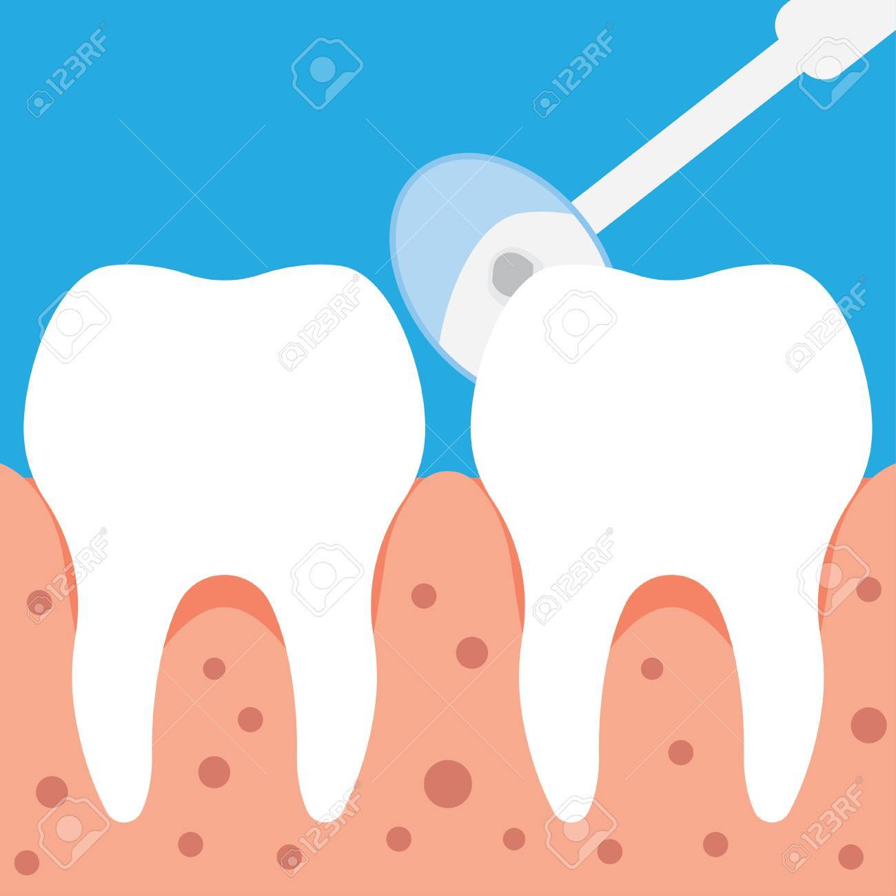 虫眼鏡 フラット スタイルで歯科検診概念で虫歯の検査手 のイラスト素材 ベクタ Image