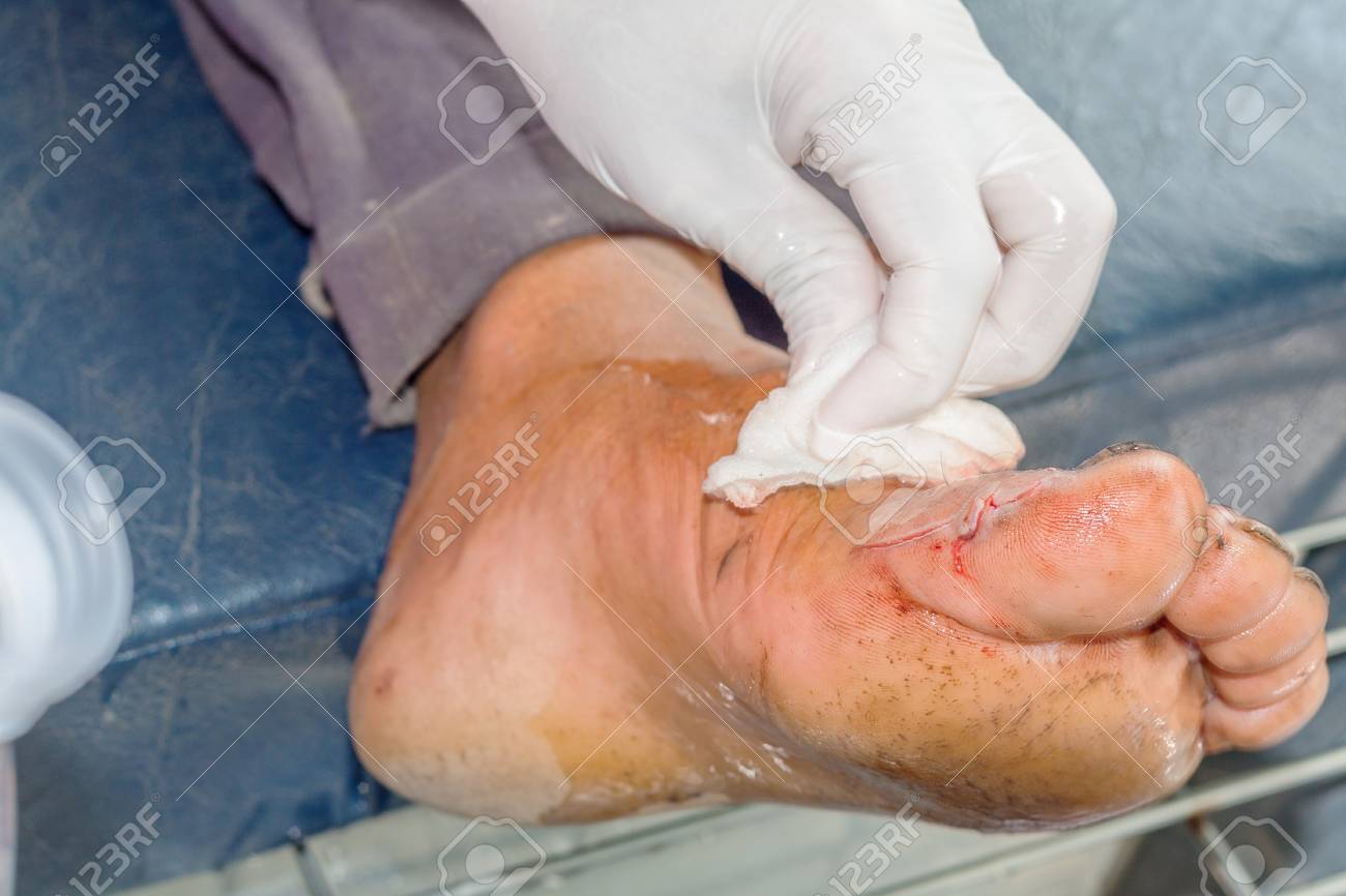 surgical wound foot of man stock photo picture and royalty free