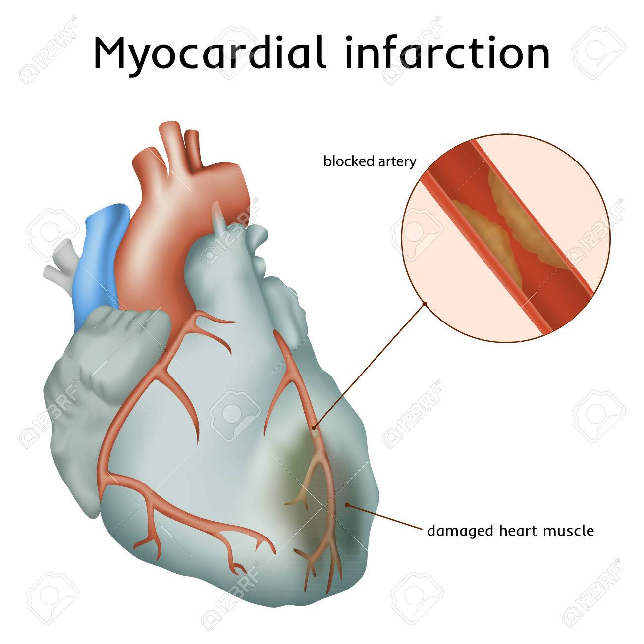 Image result for myocardial infarction