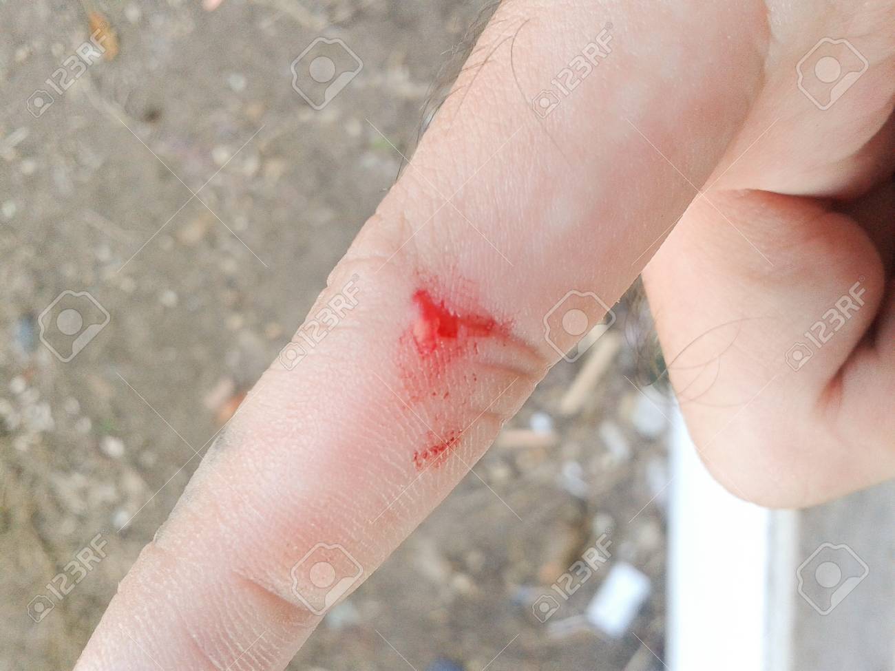 Wound On Finger Stock Photo, Picture and Royalty Free Image. Image 41145968.
