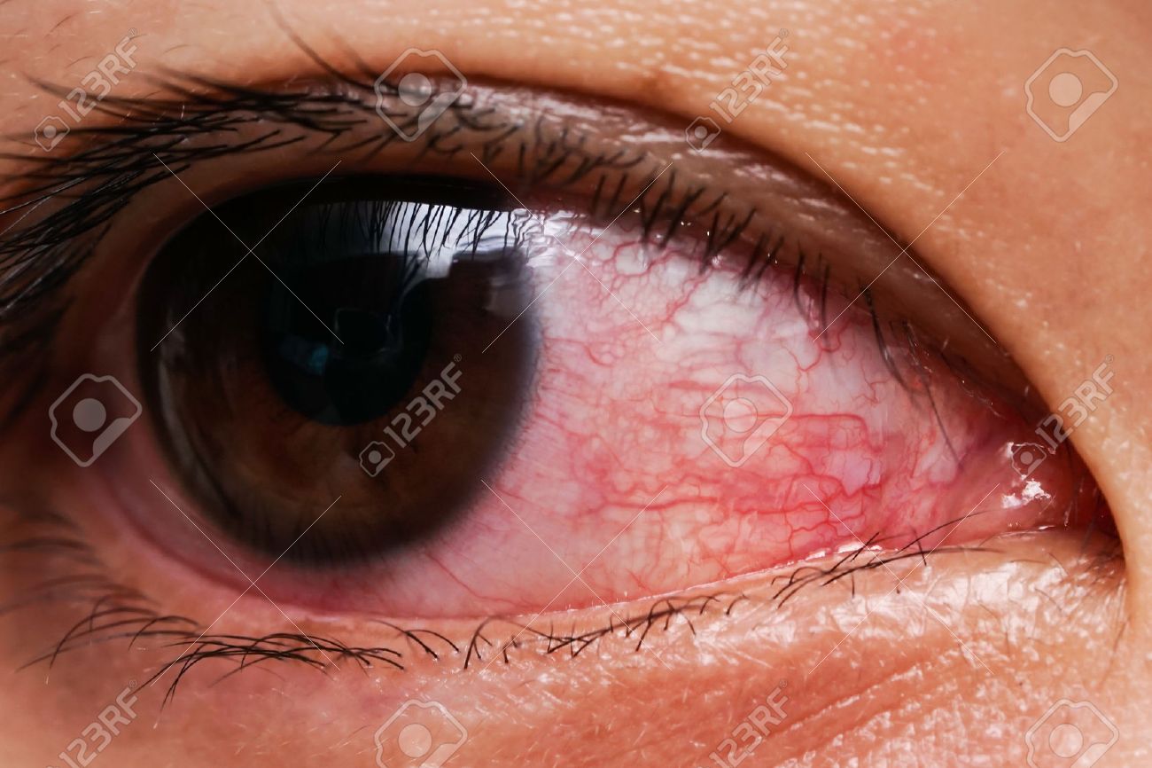 Red Eye Of Woman Conjunctivitis Eye Or After Cry Stock Photo