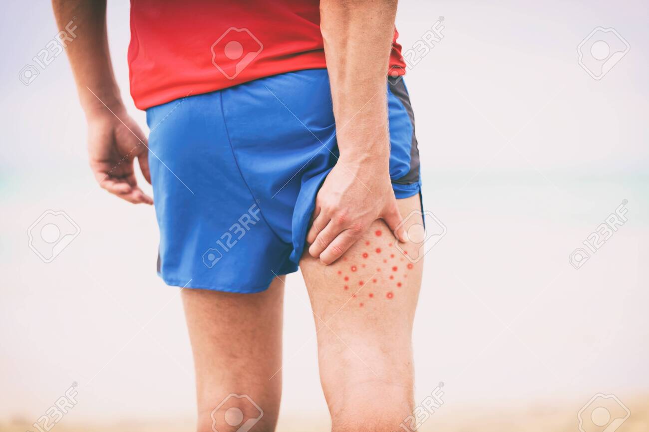 Body Acne Man Scratching Itchy Pimples On Back Leg Thigh Skin Stock Photo Picture And Royalty Free Image Image 127252991