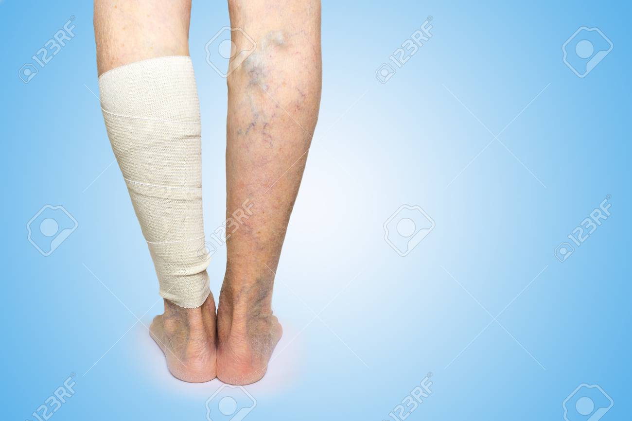 Bandaje elastice împotriva varicozei. Tratamentul cu paraziti oris. Schistosomiasis guidelines
