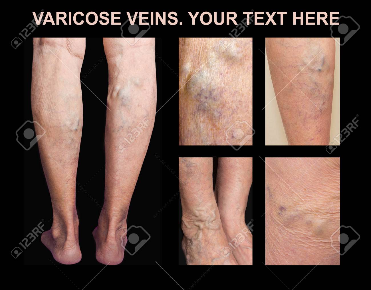 fotos de venas varicosas en las piernas fotos de venas varicosas en las piernas