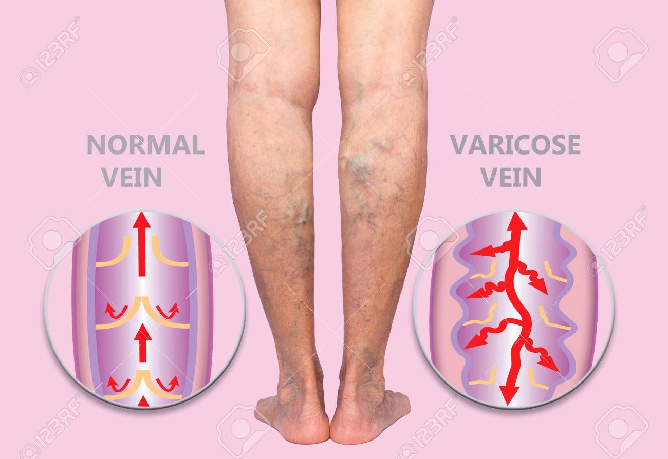 Varicose ski