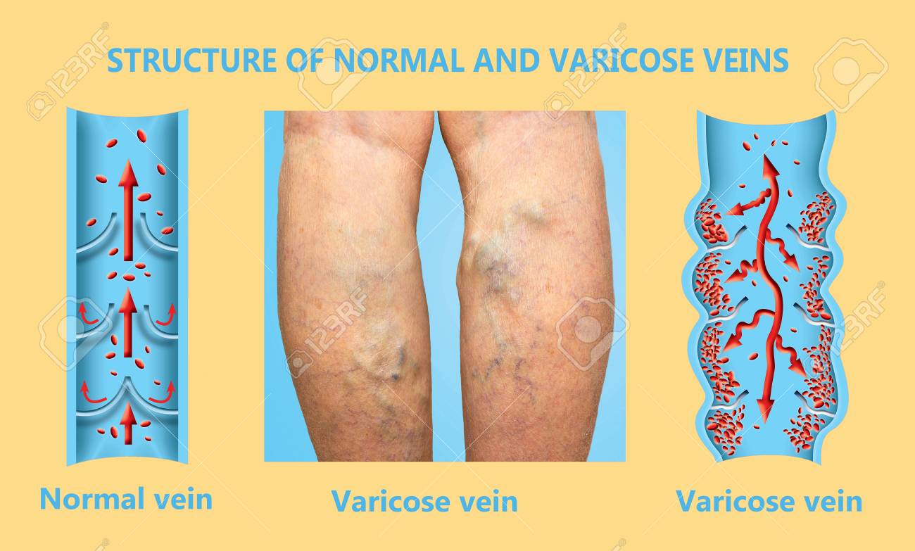 durere ascuțită în varicoză