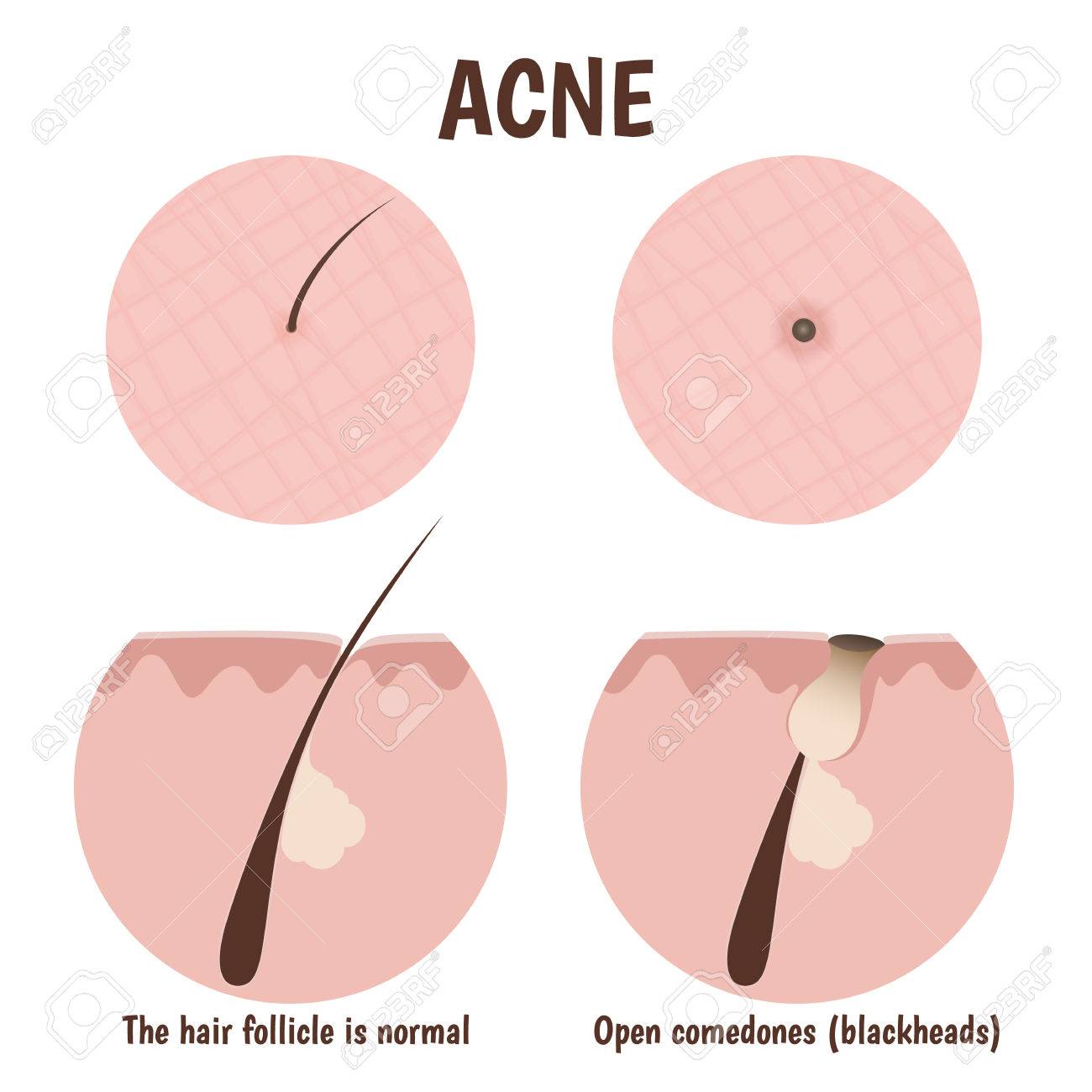structure of the hair follicle, problematic skin with blackheads - 43761446 structure of the hair follicle, problematic skin with blackheads - 43761446