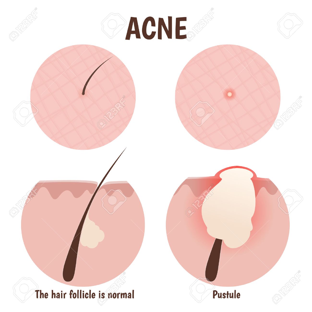 structure of the hair follicle, problem skin with pustules, pimples - 43761450 structure of the hair follicle, problem skin with pustules, pimples - 43761450