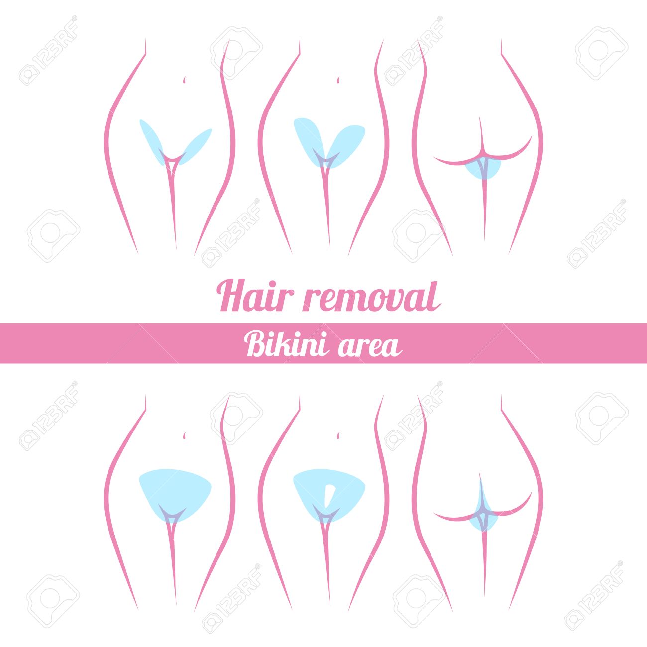 Scheme Of Hair Removal Bikini Area Laser Hair Removal Options