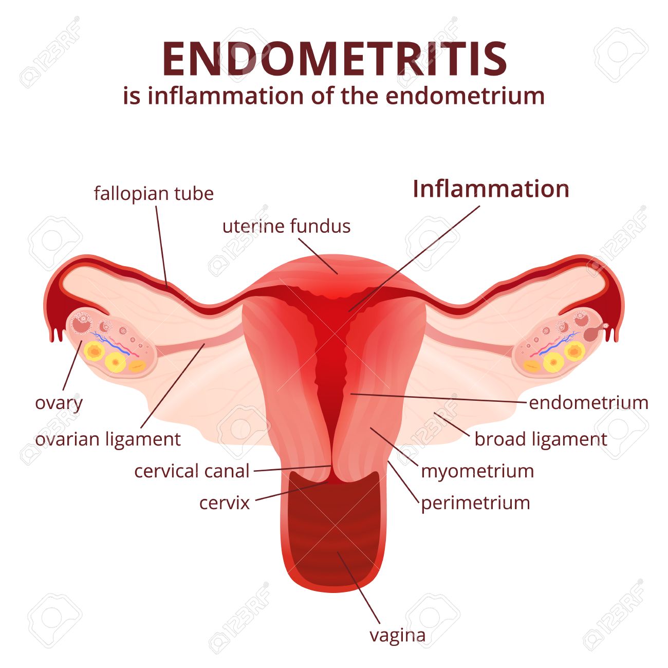 female reproductive system, the uterus and ovaries scheme, inflammation of the uterus - endometritis - 56801817 female reproductive system, the uterus and ovaries scheme, inflammation of the uterus - endometritis - 56801817