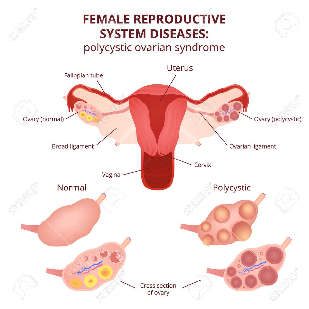 female reproductive system, the uterus and ovaries scheme, polycystic ovary syndrome, ovarian cyst - 56801820 female reproductive system, the uterus and ovaries scheme, polycystic ovary syndrome, ovarian cyst - 56801820
