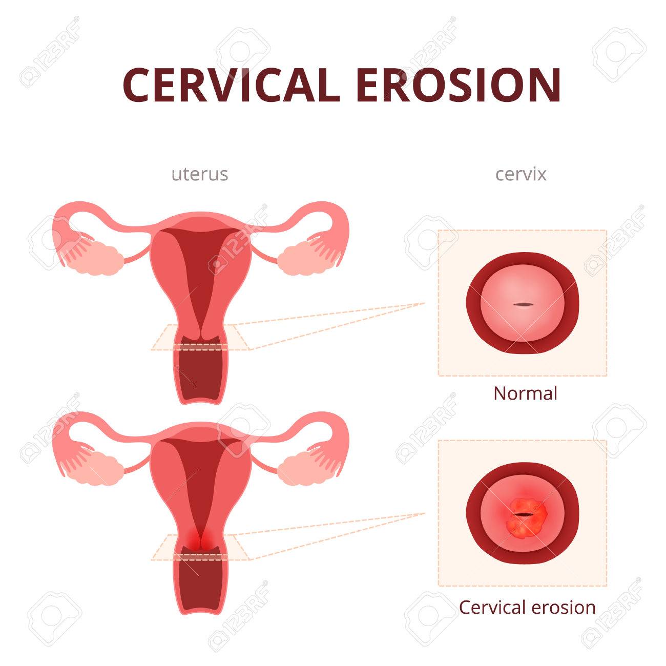 schematic illustration of the uterus and the cervix, female reproductive system diseases - 57878168 schematic illustration of the uterus and the cervix, female reproductive system diseases - 57878168