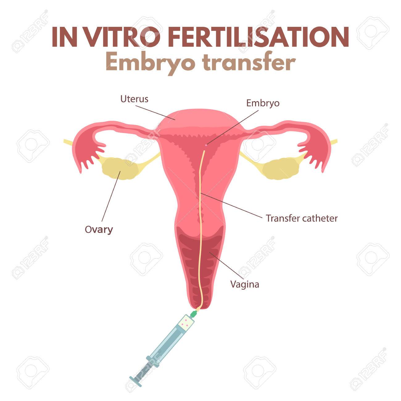 embryo transfer
