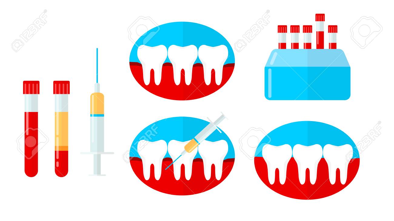 PRP set, platelet rich plasma in dentistry. Tooth, bleeding gum, syringe, centrifuge. Vector illustration in flat style - 115108607 PRP set, platelet rich plasma in dentistry. Tooth, bleeding gum, syringe, centrifuge. Vector illustration in flat style - 115108607