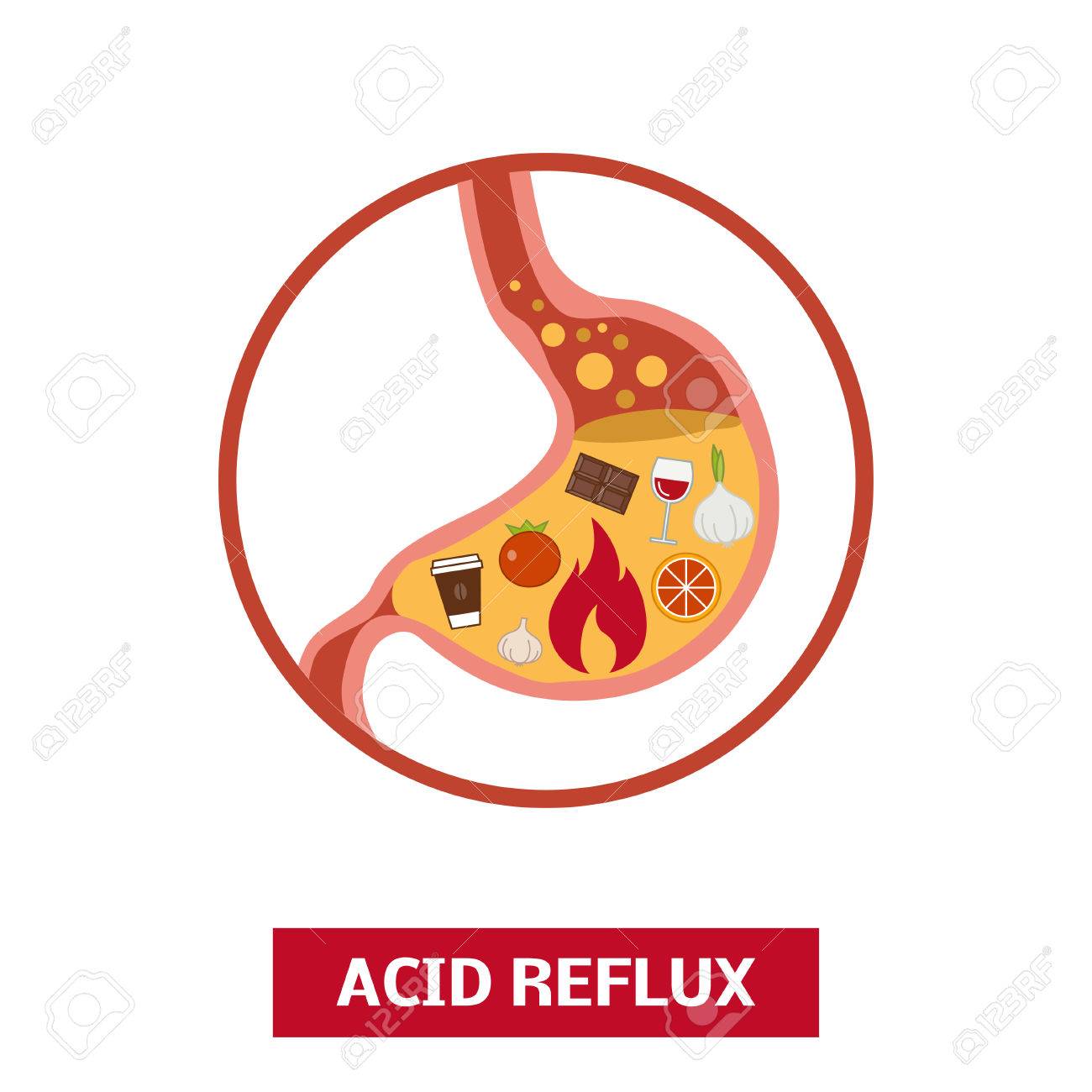 Foods That Causes Acid Reflux Or Heartburn Vector Concept Royalty foods that causes acid reflux or heartburn vector concept