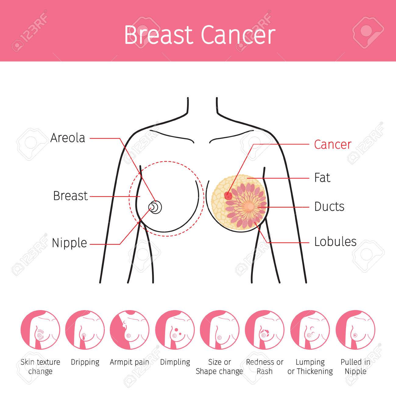 女性の母乳 アウトライン 乳房がん症状アイコン 乳腺のイラスト おっぱい 体 器官 物理ディスク 病気 健康 のイラスト素材 ベクタ Image