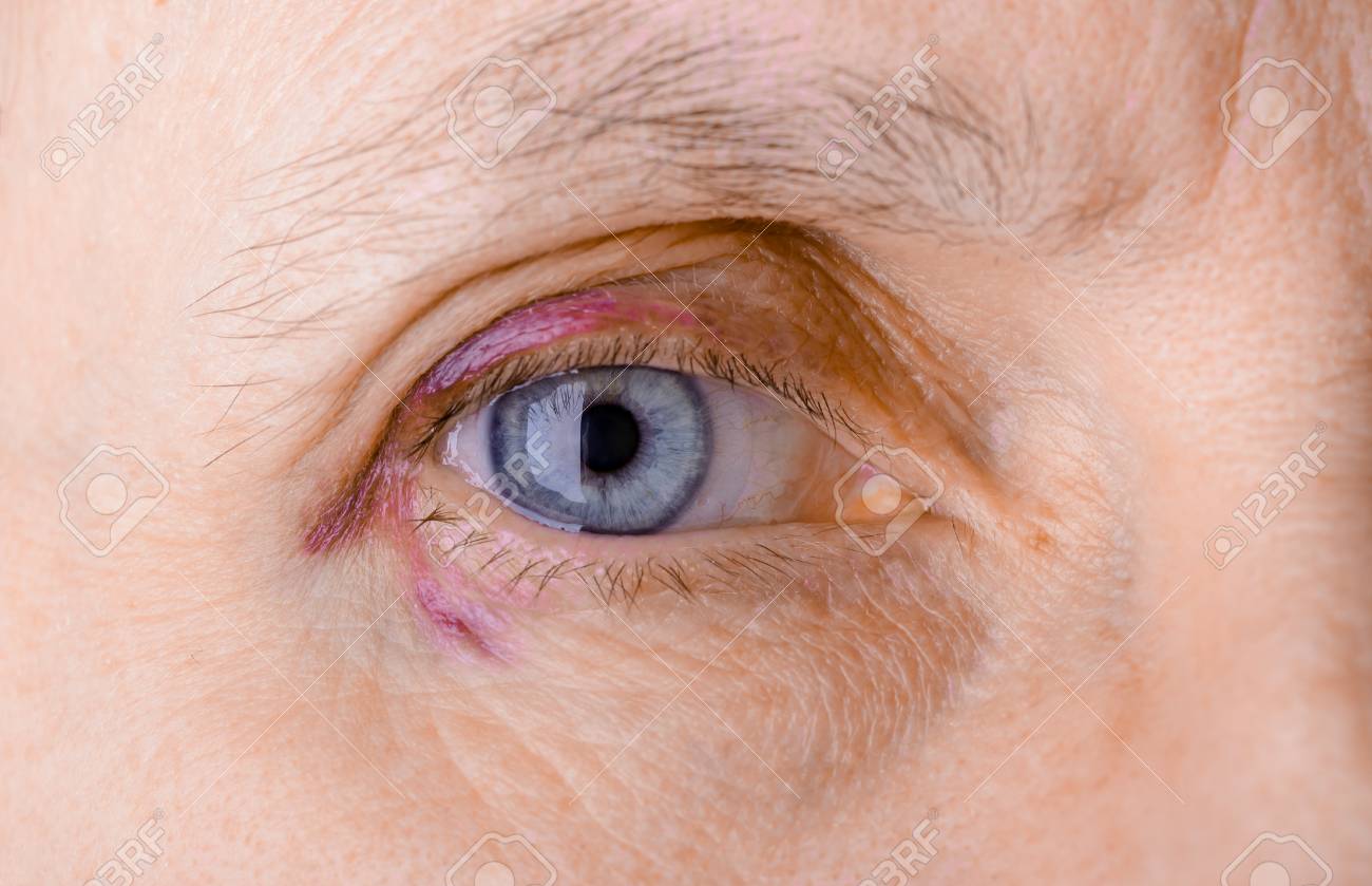que es una inflamacion ocular
