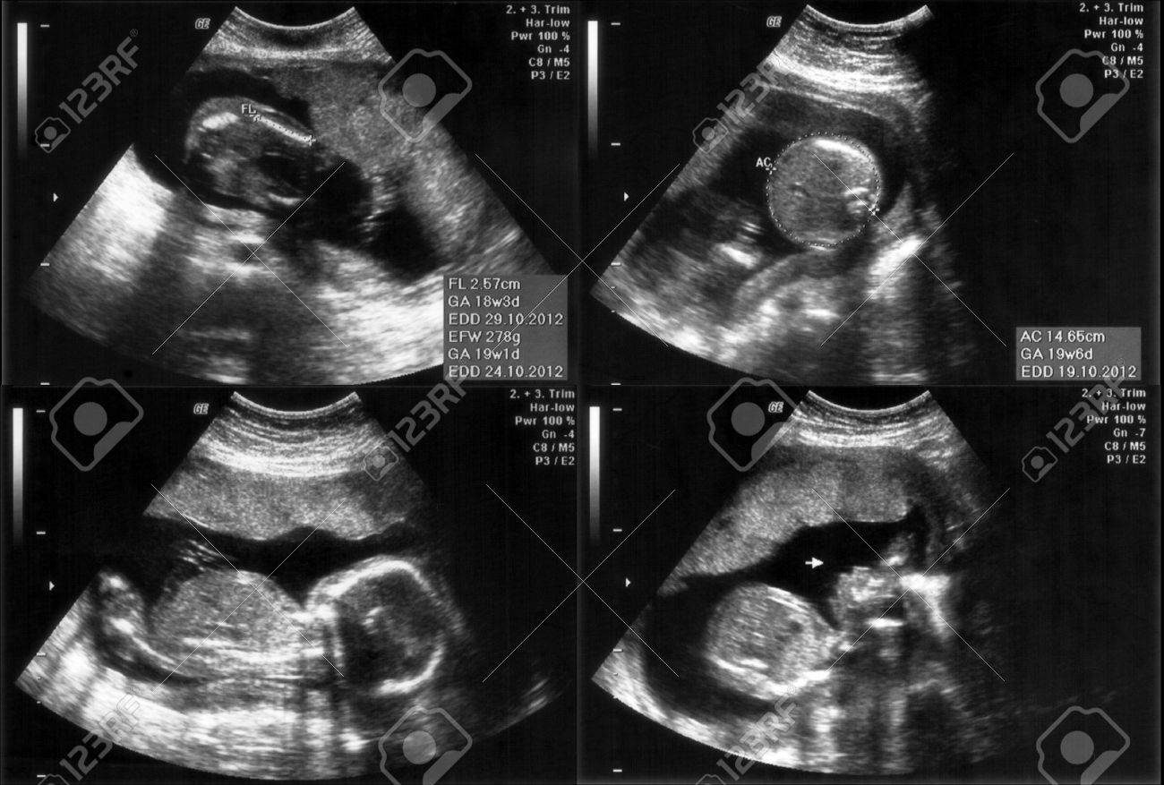 Ensemble De 4 Images Ultrasons Scan D Echographie D Un Foetus A 5 Mois Banque D Images Et Photos Libres De Droits Image Ensemble De 4 Images Ultrasons Scan D Echographie D Un Foetus A 5 Mois Banque D Images Et Photos Libres De Droits Image