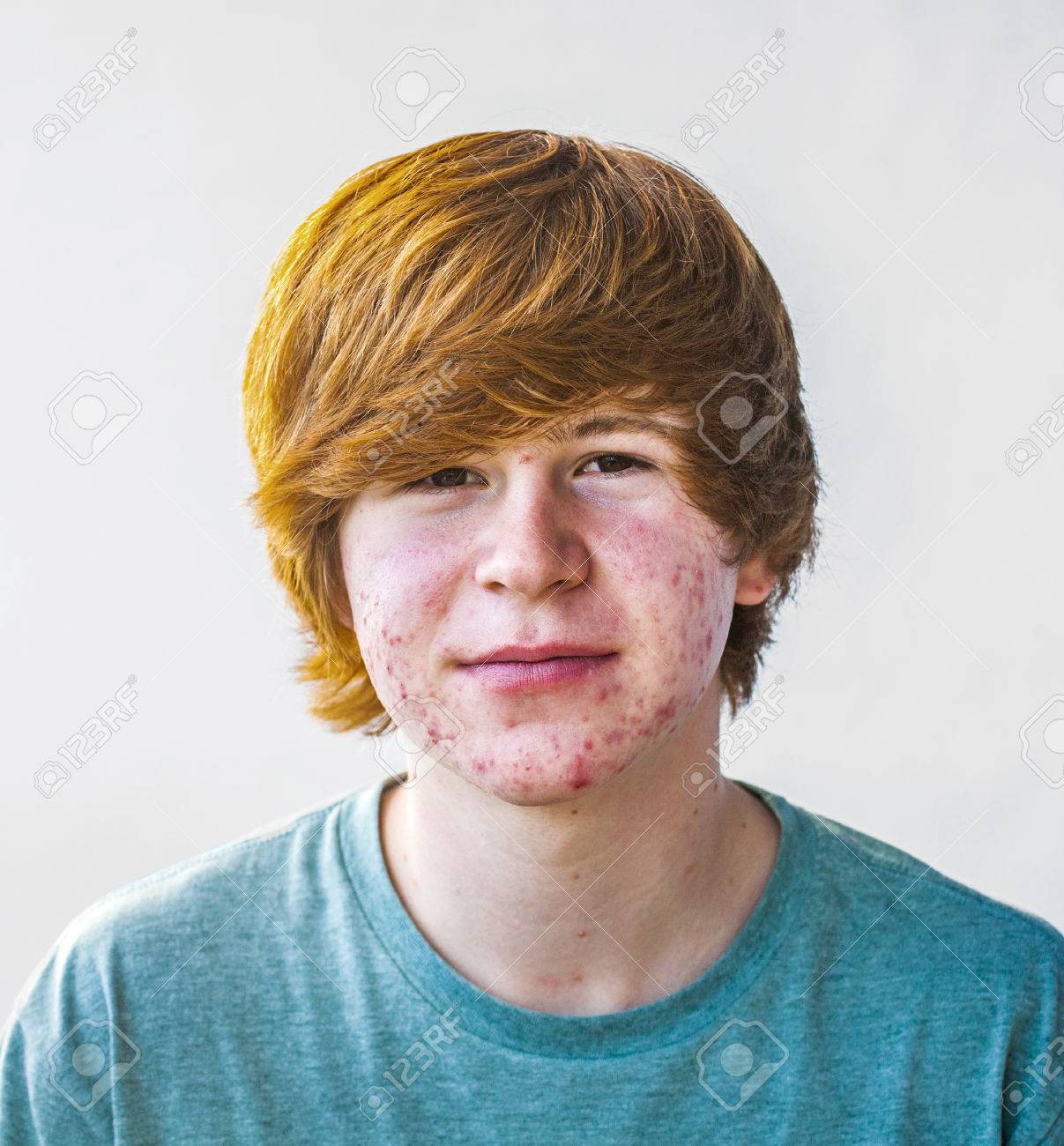 smart happy boy in puberty with acne - 44163250 smart happy boy in puberty with acne - 44163250