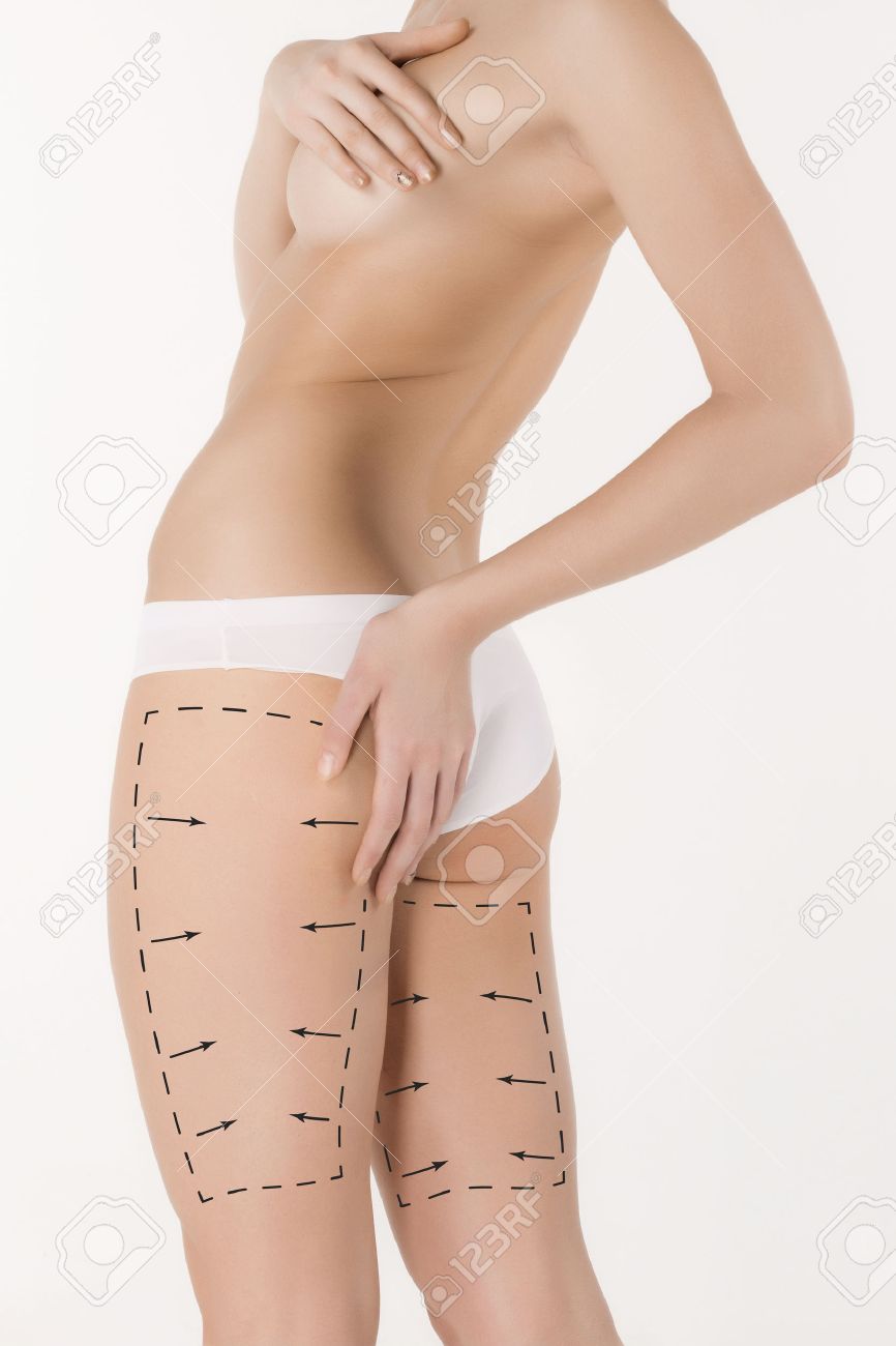 セルライト除去計画 整形手術のための準備の若い女性の体に黒いマーキング ボディ補正の概念 の写真素材 画像素材 Image