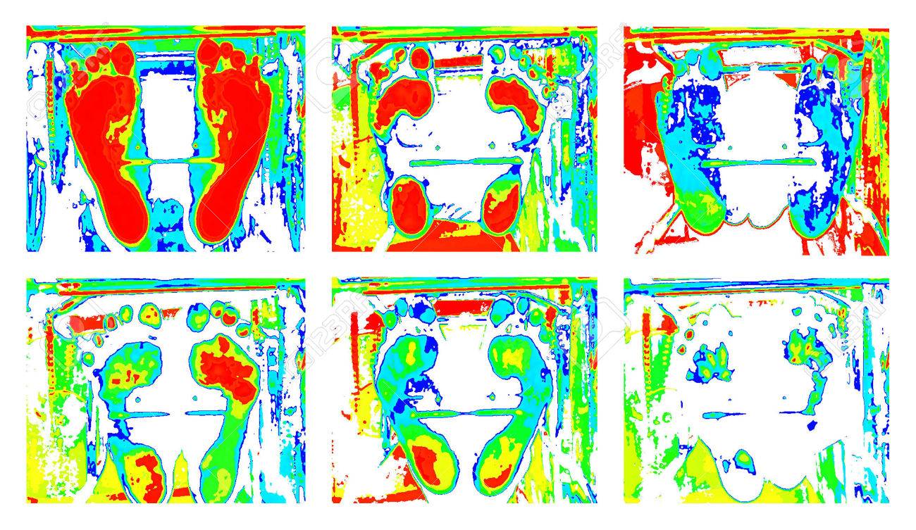 Podoskop Scanner Test Diabetes Fuss Lizenzfreie Fotos Bilder Und Stock Fotografie Image