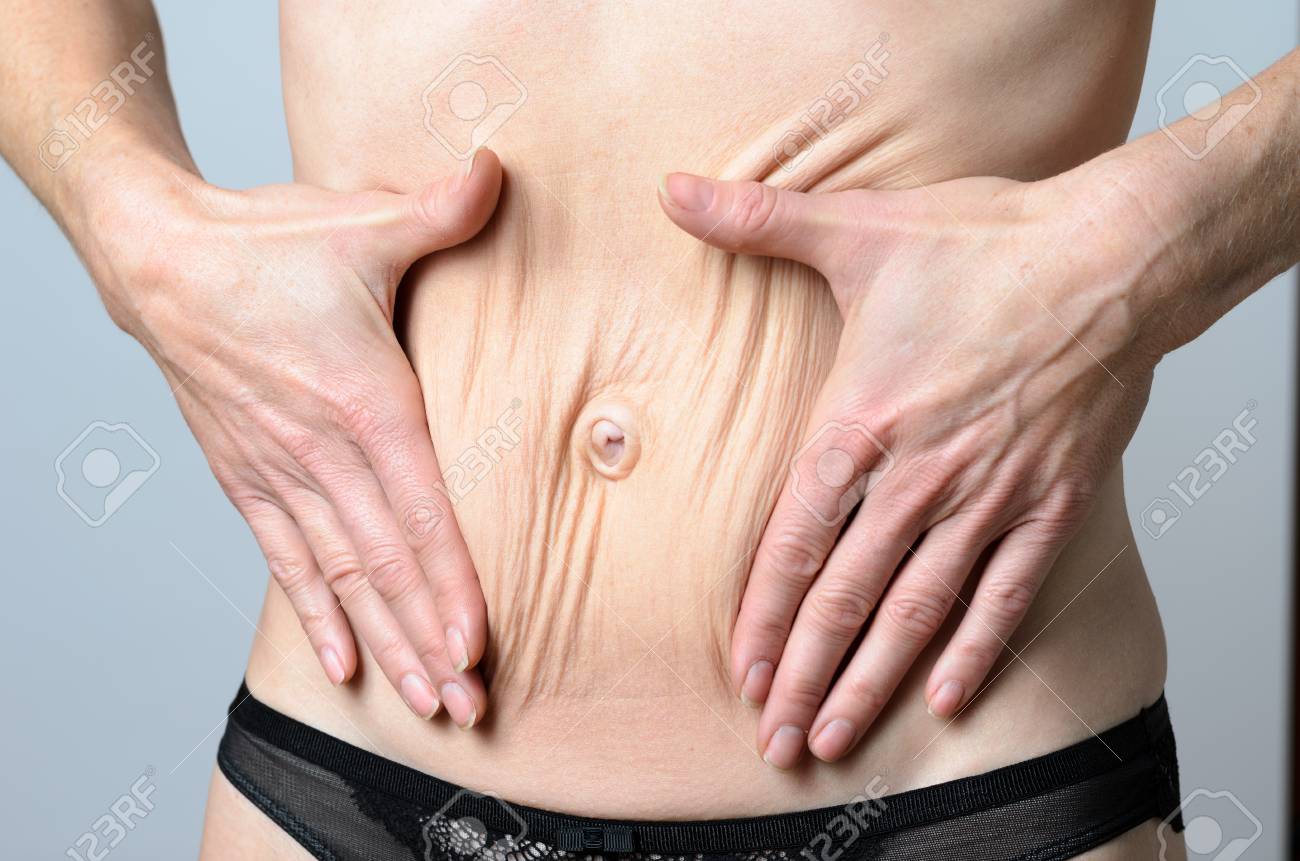 desgarro pared abdominal embarazo