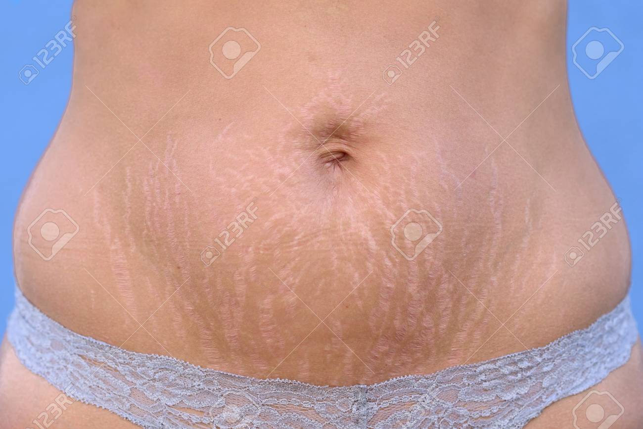 Woman Displaying Stretch Marks On Her Abdomen After Pregnancy Stock Photo Picture And Royalty Free Image Image 106640321