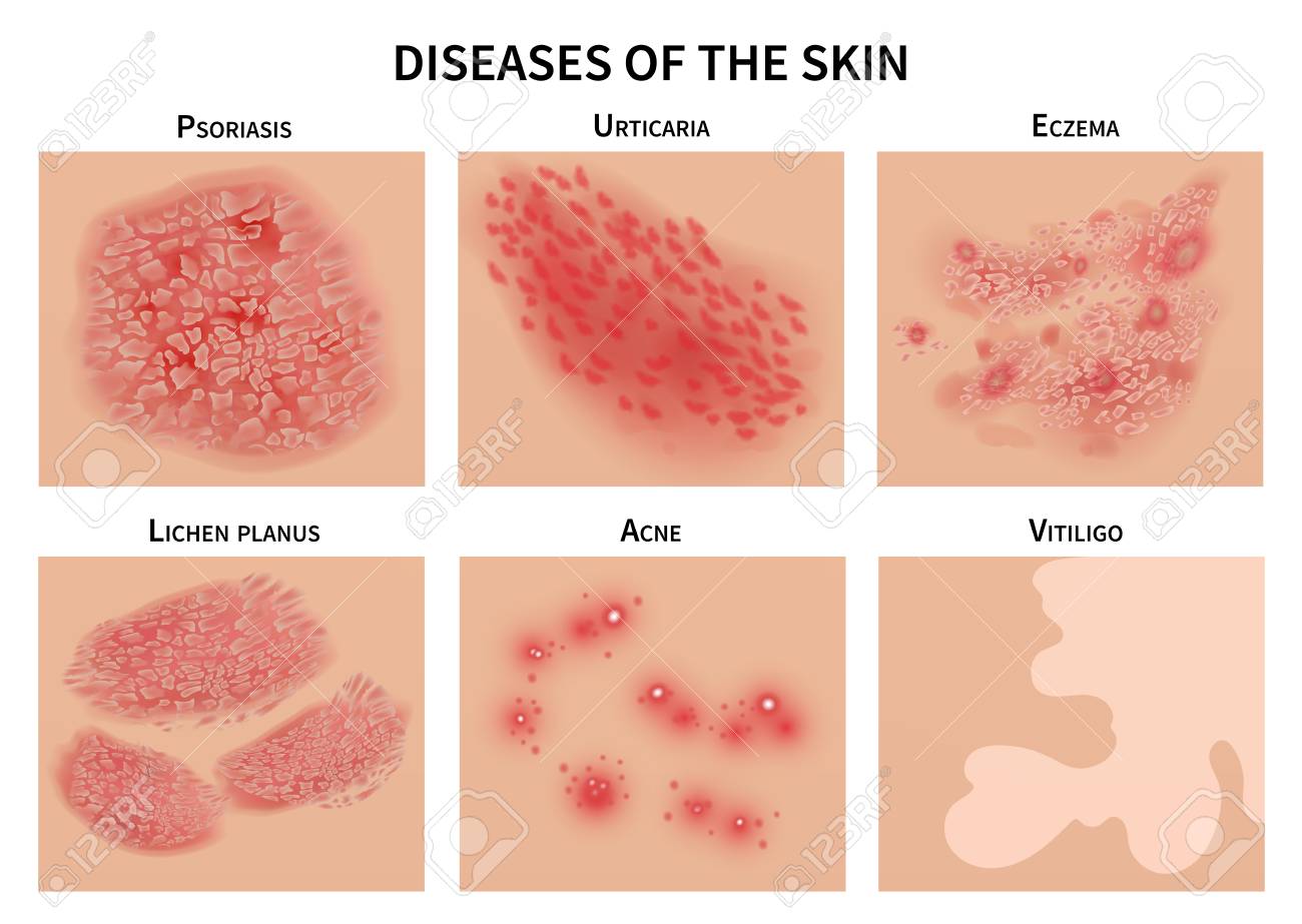 Skin diseases. Derma infection, eczema and psoriasis. Dermatology vector illustration - 106838009 Skin diseases. Derma infection, eczema and psoriasis. Dermatology vector illustration - 106838009