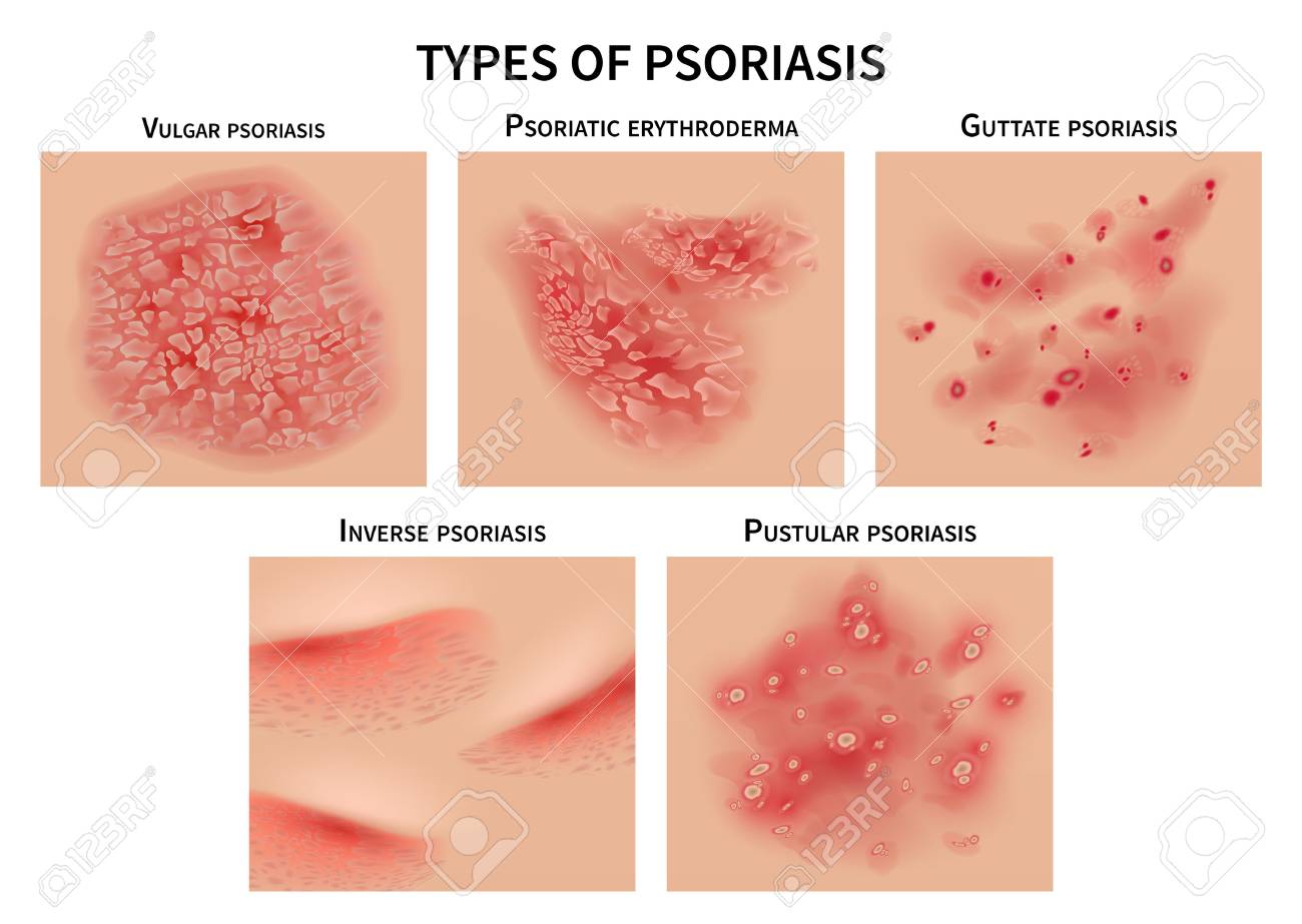 Psoriasis types. Skin hives, derma diseases. Closeup medical vector illustration. Dermatology allergy, medical itch and rash, symptom of epidermis - 111588972 Psoriasis types. Skin hives, derma diseases. Closeup medical vector illustration. Dermatology allergy, medical itch and rash, symptom of epidermis - 111588972