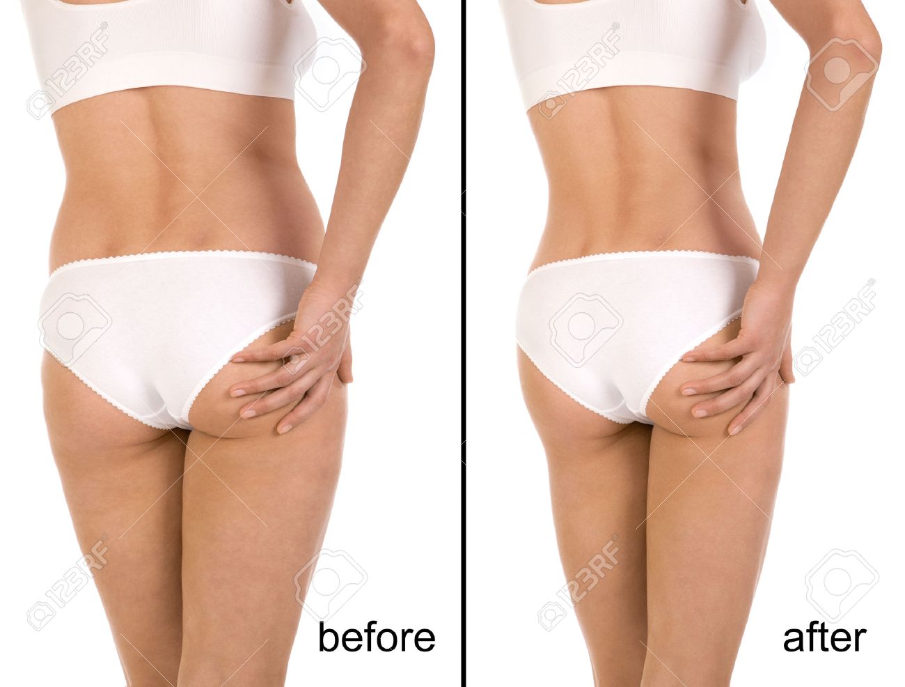 Cellulite Bilder vor und nach Gewichtsverlust