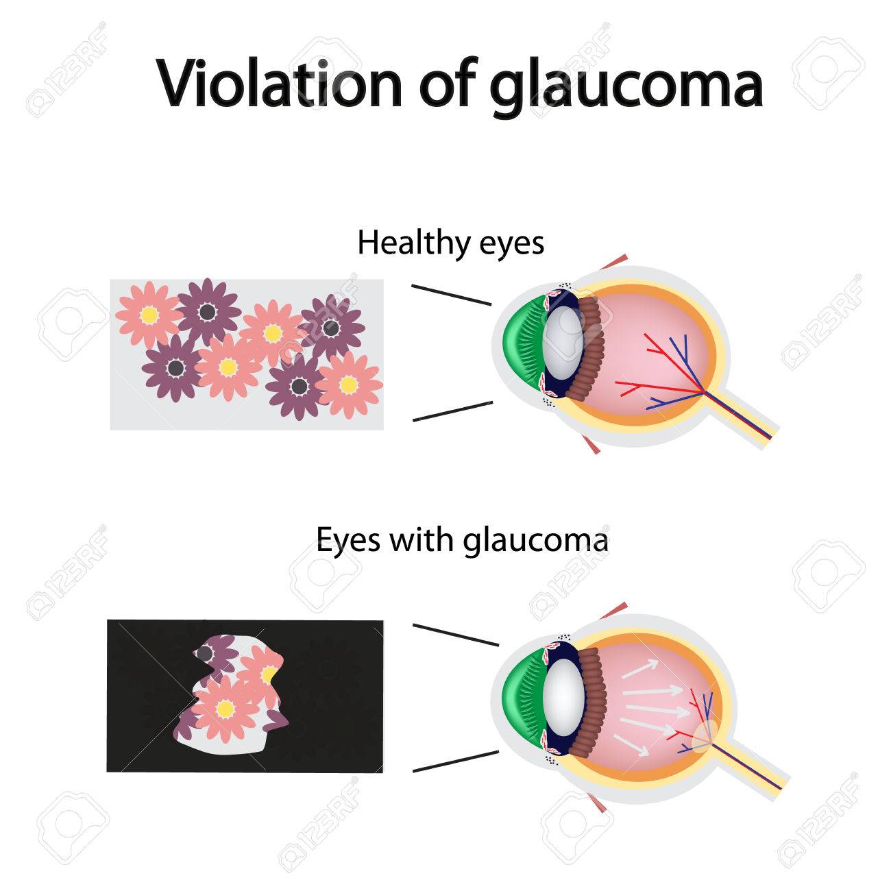 The structure of the eye. Blurred vision in glaucoma. As the eye can see the affected with glaucoma. - 40048329 The structure of the eye. Blurred vision in glaucoma. As the eye can see the affected with glaucoma. - 40048329