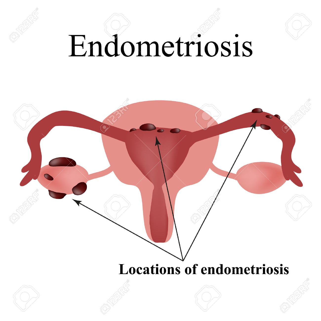 Endometriosis. Endometrial cysts. The structure of the pelvic organs. Gynecology. Infographics. illustration on isolated background. - 52407242 Endometriosis. Endometrial cysts. The structure of the pelvic organs. Gynecology. Infographics. illustration on isolated background. - 52407242