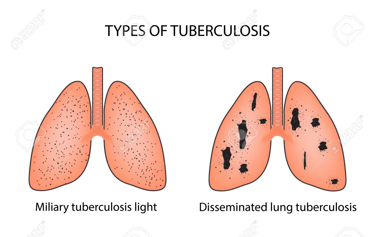 265Lu Miliary TB | The Common Vein, image size:1300x823