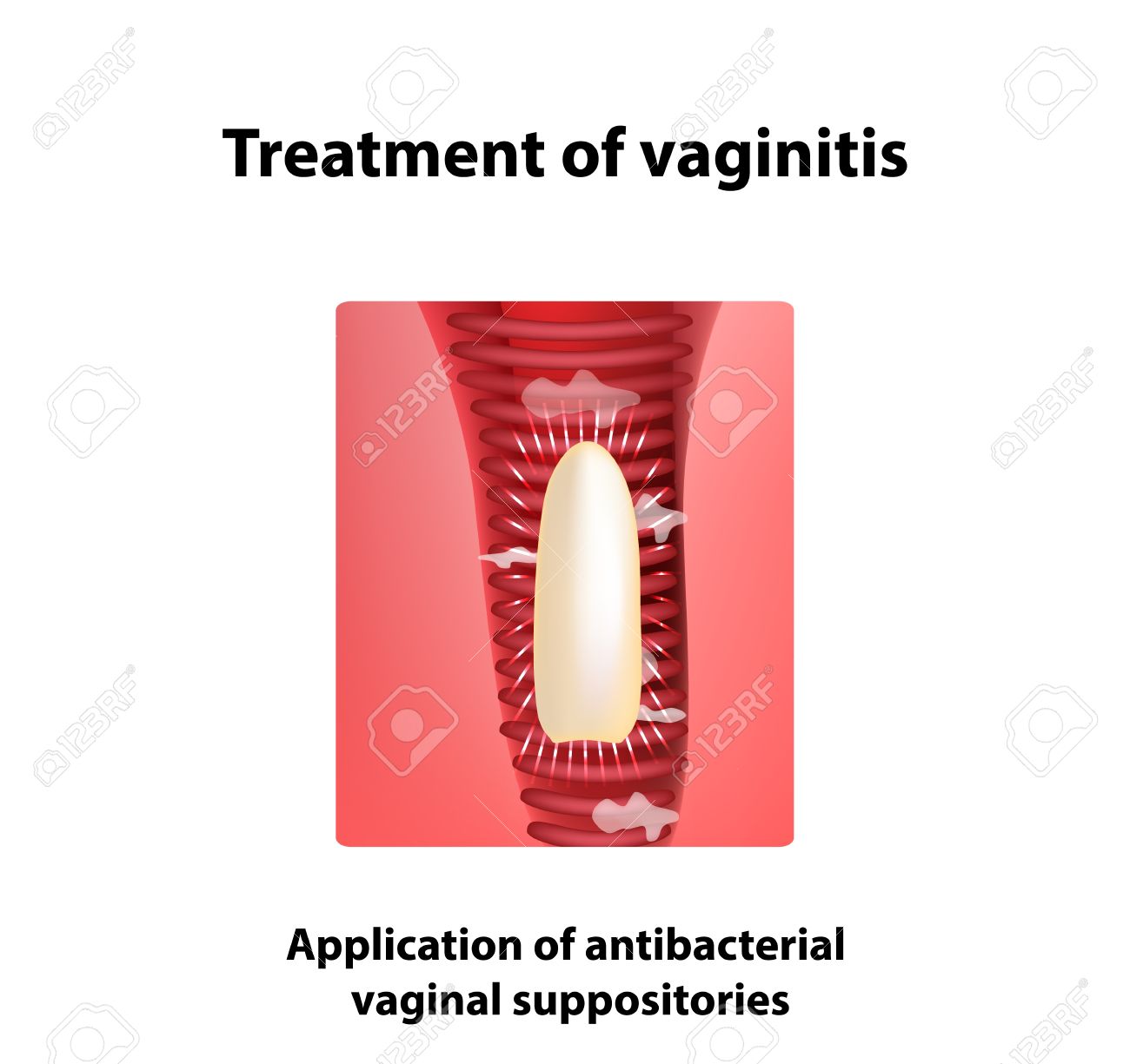 Inflammation of the vagina. Treatment 92 Inflammation of the vagina. Treatment 27
