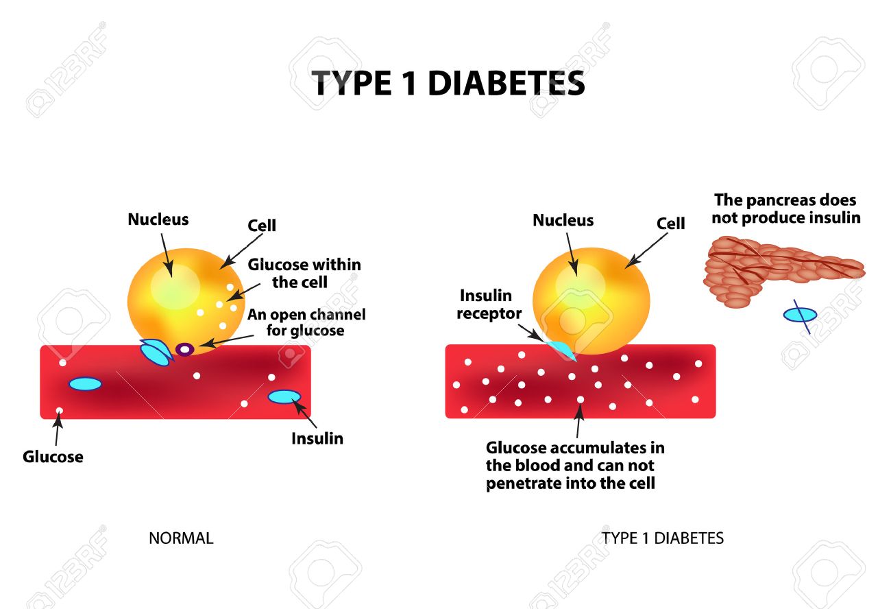 diabetes nivel de azúcar en la sangre 300