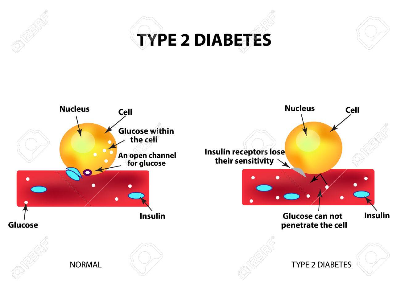 diagramas de diabetes tipo 2 de células diagramas de diabetes tipo 2 de células