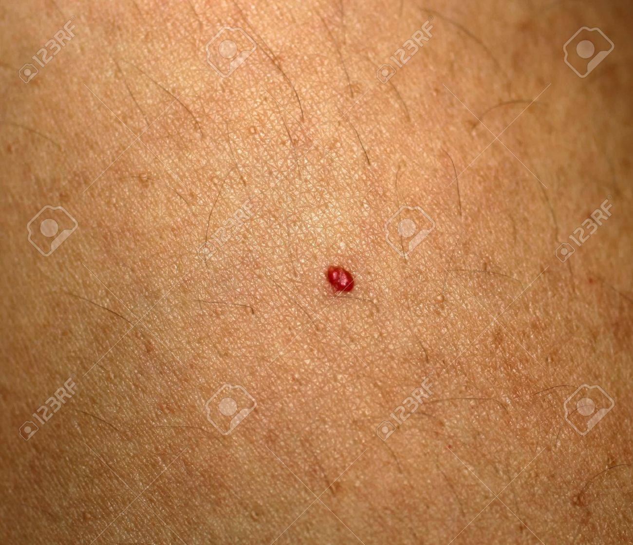 Red mole on skin